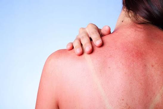Des pratiques naturelles anti coup de soleil.