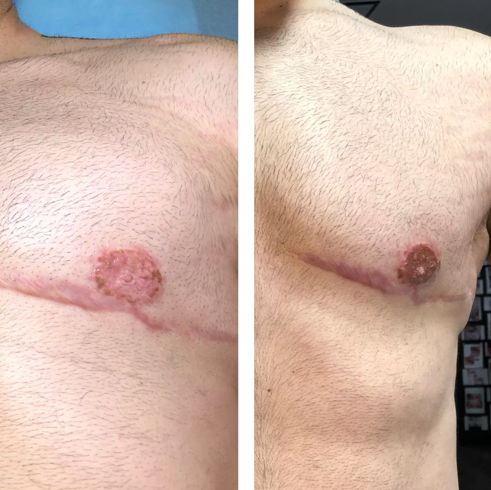 Dérmopigmentation correctrice