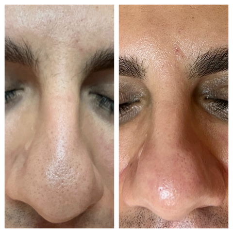 Soin Hydrofacial Avant/Après - 1 séance