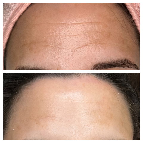 Soin Hydrofacial Avant/Après - 1 séance