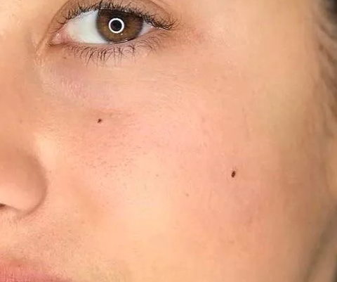 Grain de beauté
