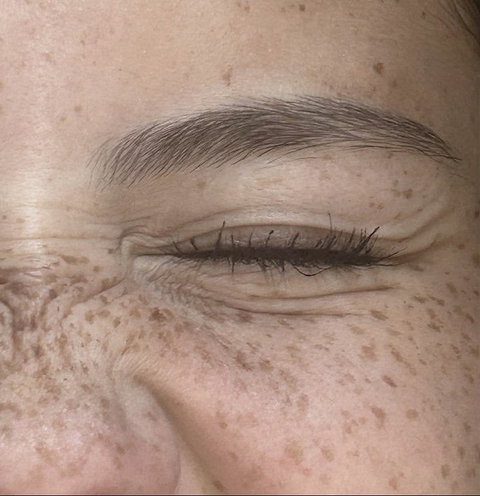 Taches de Rousseur