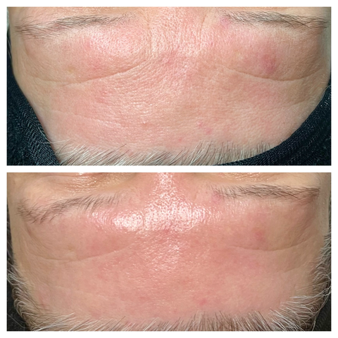 No Botox Avant / Après - 1 séance
