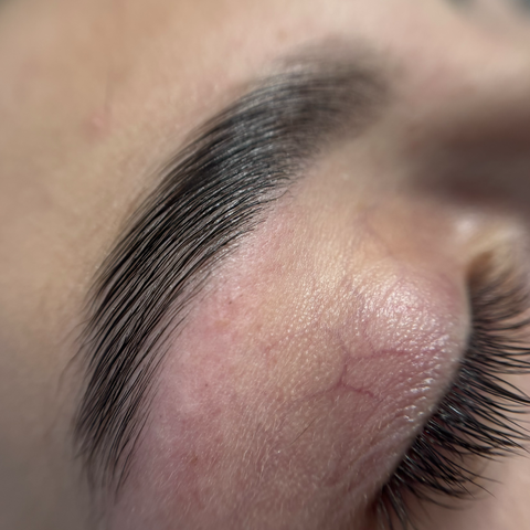 Browlift
