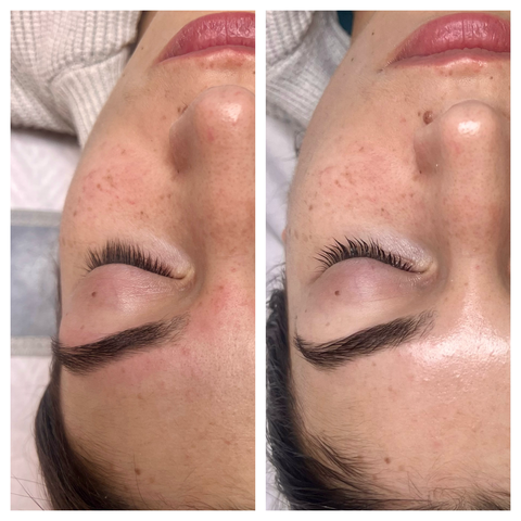 Hydrofacial avec masque Carboxythérapie